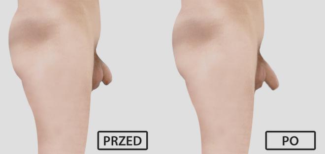 Naturalne metody powiększania