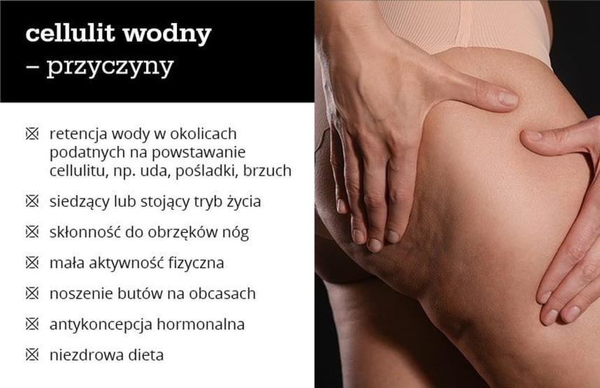 Porady dotyczące cellulitu