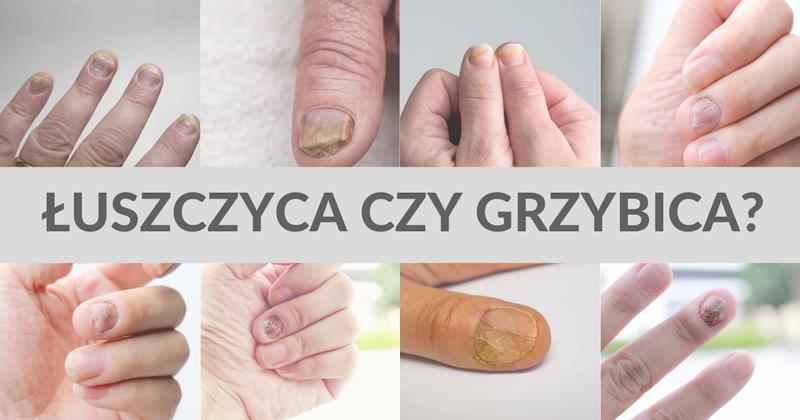 Różnice łuszczyca a grzybica